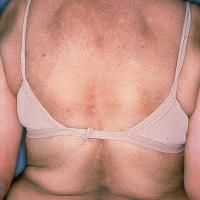 
	Malignant AN associated with carcinoma of the…