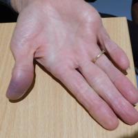 Achenbach syndrome
Copied with kind permission…