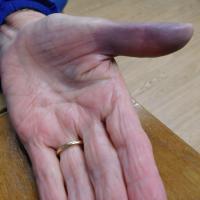 Achenbach syndrome
Copied with kind permission…
