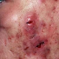 
	Acne conglobata

	Copied with kind permission…