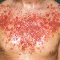 
	Acne fulminans&nbsp;

	Copied with kind…