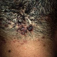 
	Acne keloidalis nuchae