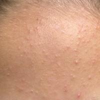 
	Acne with closed comedones (whiteheads)