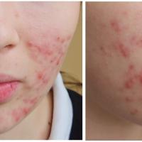 Papules, pustules, and nodules in a…
