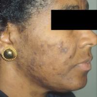 
	Hyperpigmentation resulting from acne 

	Copied…