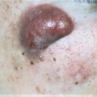 Severe cystic acne
Copied with kind permission…