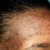 
	Pomade acne

	&nbsp;