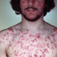 
	Severe acne