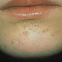 Acne with open comedones (blackheads)