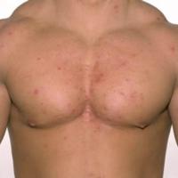 Acne secondary to anabolic steroids