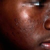 Moderate inflammatory acne with…