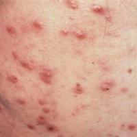 Moderate inflammatory acne with papules and…