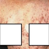 Acne secondary to lithium
Copied with kind…