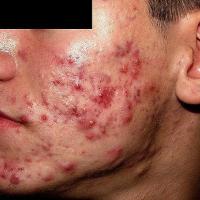 
	Severe inflammatory acne; many pustules and…