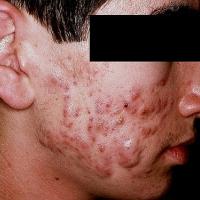 
	Severe acne with nodules
	
	Copied with kind…