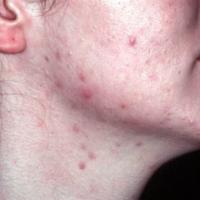 Mild papular/pustular acne