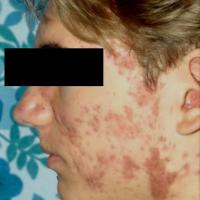 
	The start of atrophic scarring

	This has…