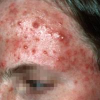Moderate acne