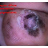 Acral lentiginous melanoma