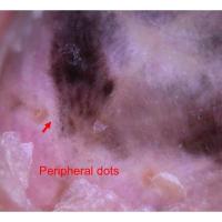 Acral lentiginous melanoma - very chaotic