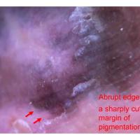 Acral lentiginous melanoma