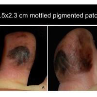 Acral lentiginous melanoma