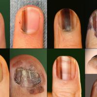 All images are melanomaCopied with kind…