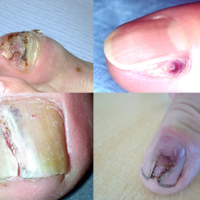 Four cases of nail bed melanoma&nbsp;This type of…
