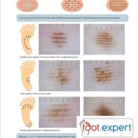Benign acral naevi of the plantar foot - site…
