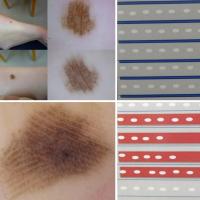 Benign acral naevi vs acral lentiginous…