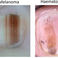 Comparison - melanoma (left) and haematoma…