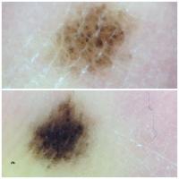 An evolving acral lentiginous melanomaEven in the…