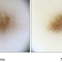 Fibrillar comparisonThe fibrils in the melanoma…