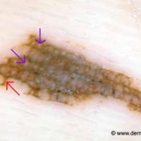 Benign melanocytic naevus - lattice-like…