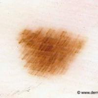 Benign melanocytic naevus - fibrillar…
