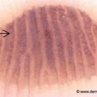 Dermoscopic appearance of an acral…
