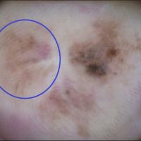 Dermoscopic appearance of previous figureChaos of…