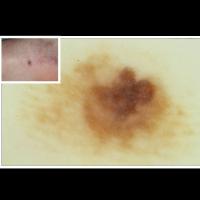 Acral lentiginous melanomaChaos of colours…