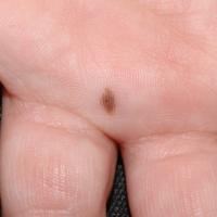 
	Benign melanocytic naevus on the palm