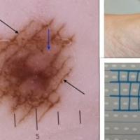 Benign melanocytic naevus - lattice-like…