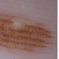 Benign melanocytic naevus - an incomplete…