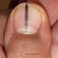 Nail matrix melanoma