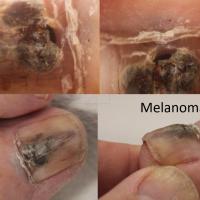 Nail matrix melanoma starting to damage the nail