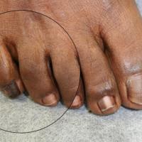 This patient also had a melanoma (little…