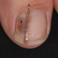 Nail matrix melanoma and haemorrhage&nbsp;The…