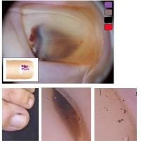Subungual haemorrhageNeither of these is a…