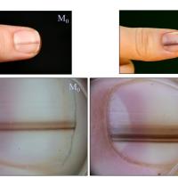 Nail matrix melanoma in situIn general, nail…
