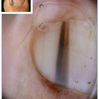 Nail matrix melanomaWider at the baseCopied with…