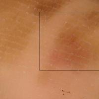 Acral lentiginous melanomaWhite fibrils (a…