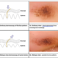 Oblique dermoscopy of a benign fibrillar pattern